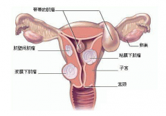 子宫肌瘤怎么治疗